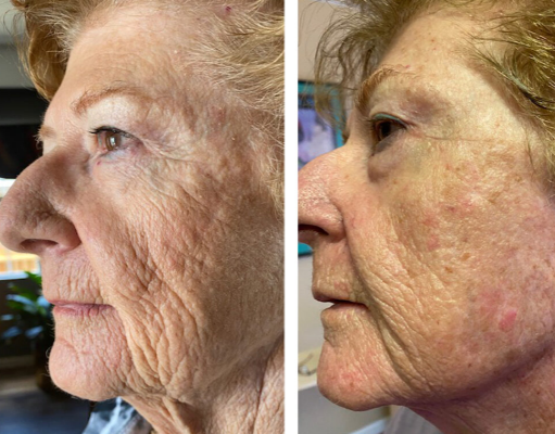 SkinGlow Pro™ - LED Neck & Face Lifting Device