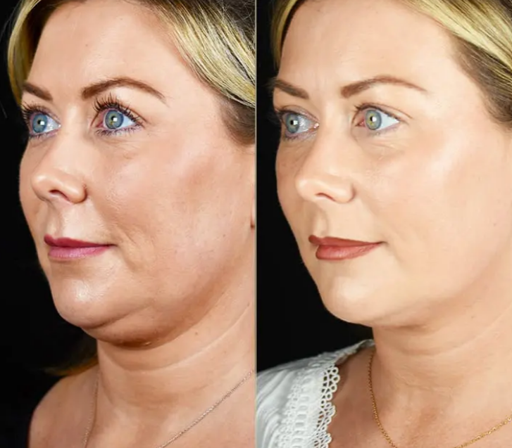 SkinGlow Pro™ - LED Neck & Face Lifting Device